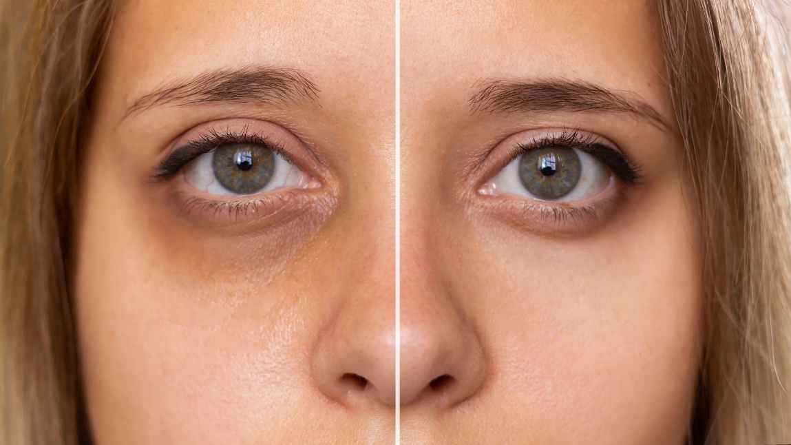 How to Get Rid of Dark Circles Under the Eyes