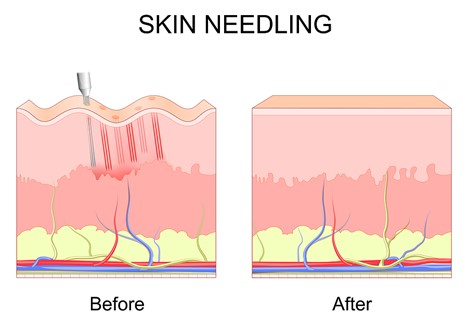 Microneedling