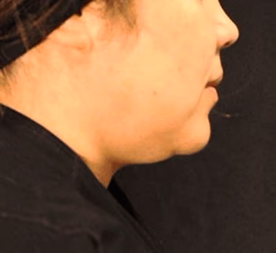 Double Chin Removal: Face Sculpting with SculpSure®