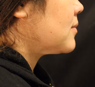 Double Chin Removal: Face Sculpting with SculpSure®
