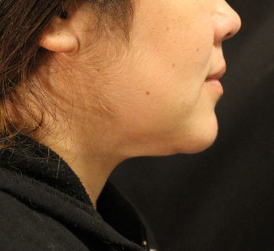 Double Chin Removal: Face Sculpting with SculpSure®
