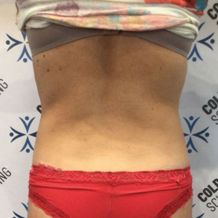 B-Shape T.M.C. Body Contouring