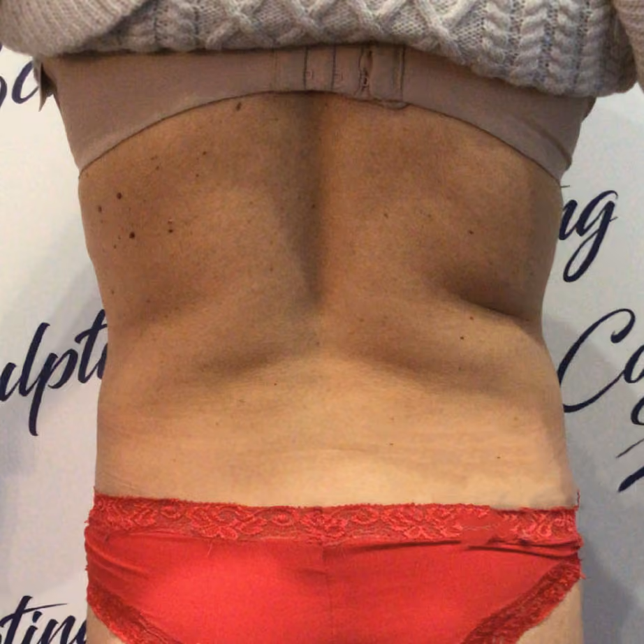 B-Shape T.M.C. Body Contouring