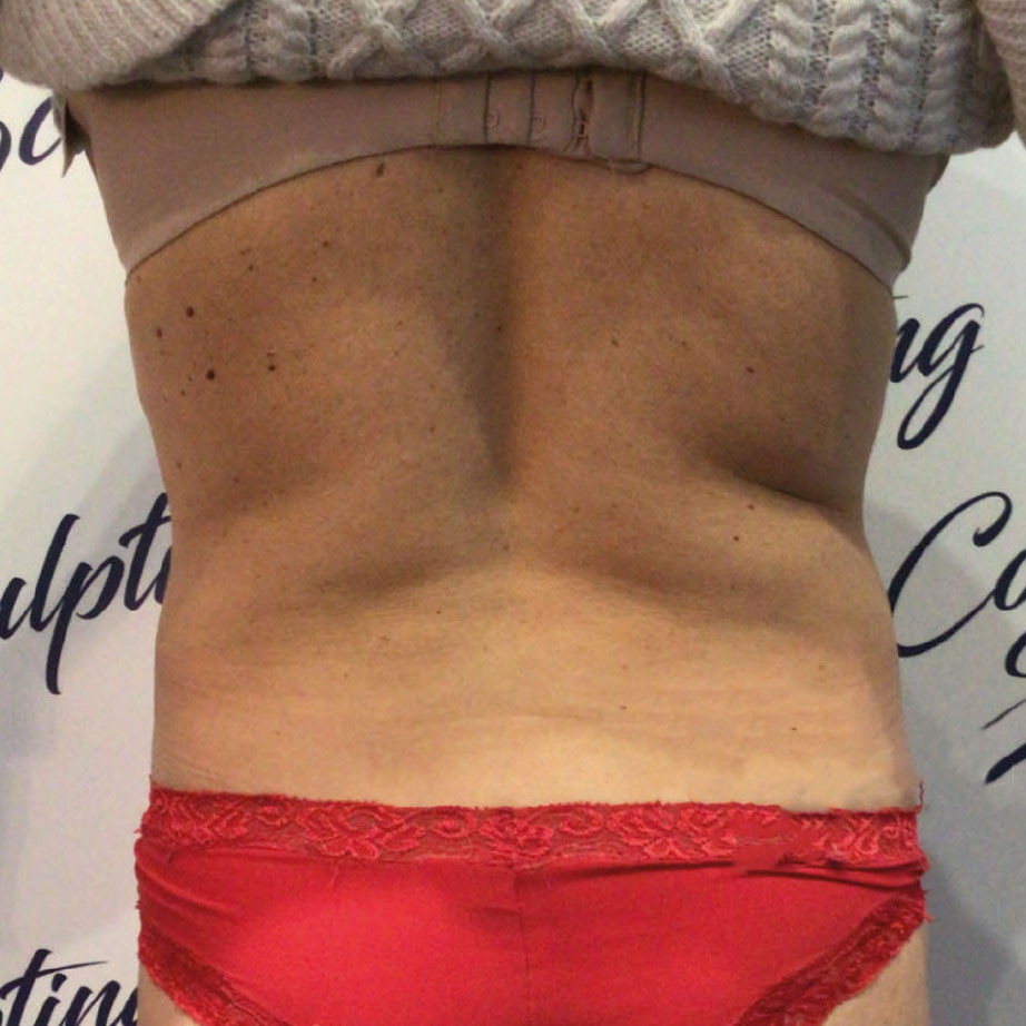 B-Shape T.M.C. Body Contouring
