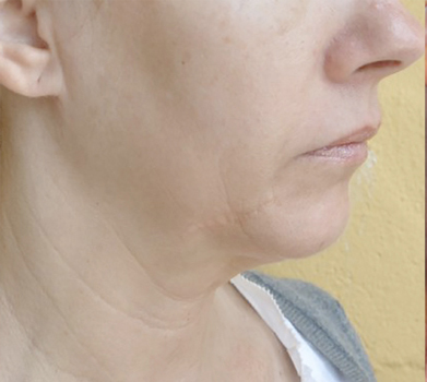 FORMA Skin Tightening Treatment