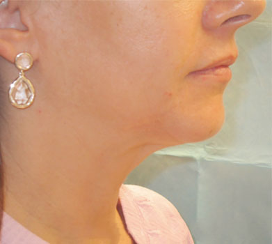 FORMA Skin Tightening Treatment