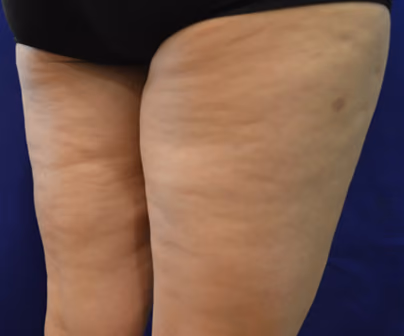 BodyFX and MiniFX Cellulite Treatment