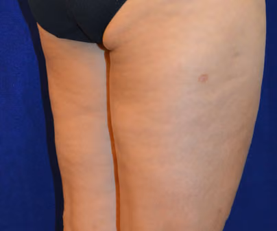 BodyFX and MiniFX Cellulite Treatment