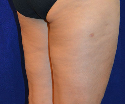 BodyFX and MiniFX Cellulite Treatment