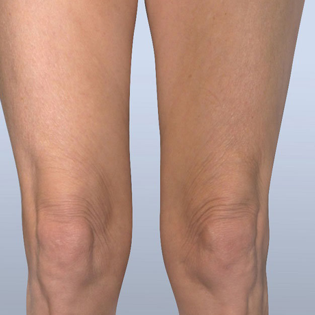 DiolazeXL Laser Hair Removal Treatment