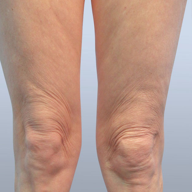 DiolazeXL Laser Hair Removal Treatment