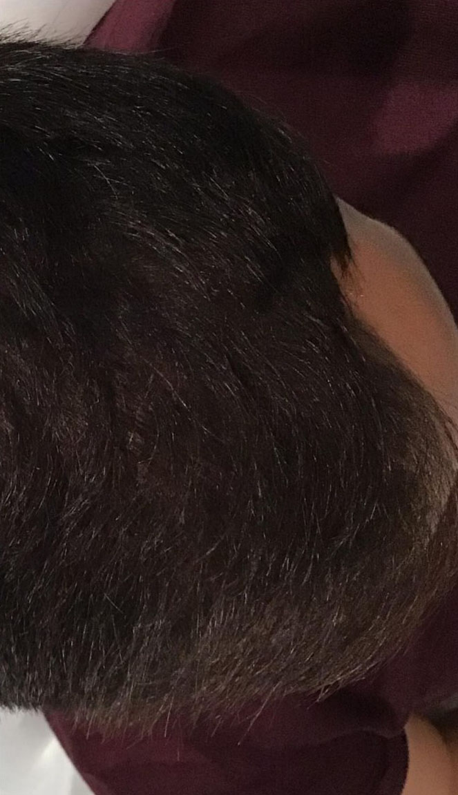 Hair Restoration – Advanced Adipose Protein Extract (AAPE)