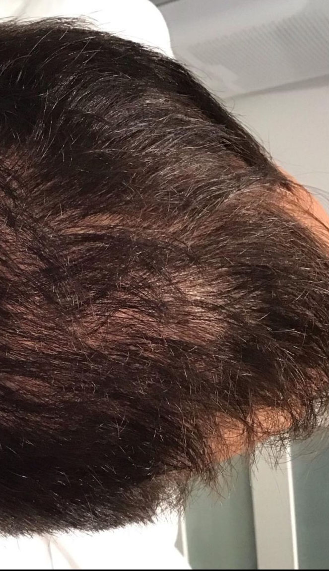 Hair Restoration – Advanced Adipose Protein Extract (AAPE)