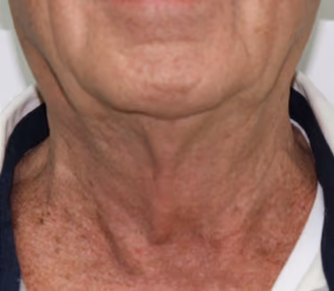 Fractora Rejuvenating Micro-needling Skin Treatment