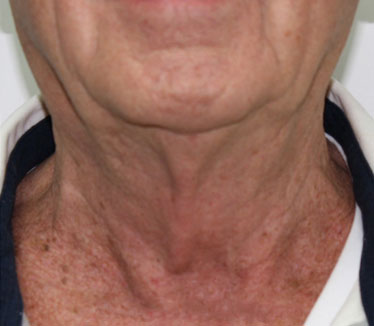Fractora Rejuvenating Micro-needling Skin Treatment