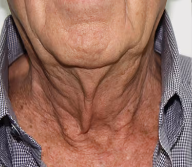 Fractora Rejuvenating Micro-needling Skin Treatment