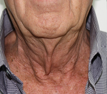 Fractora Rejuvenating Micro-needling Skin Treatment