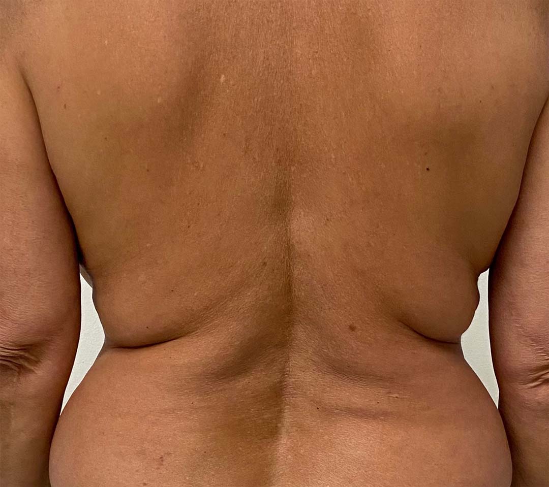 Morpheus8 Body