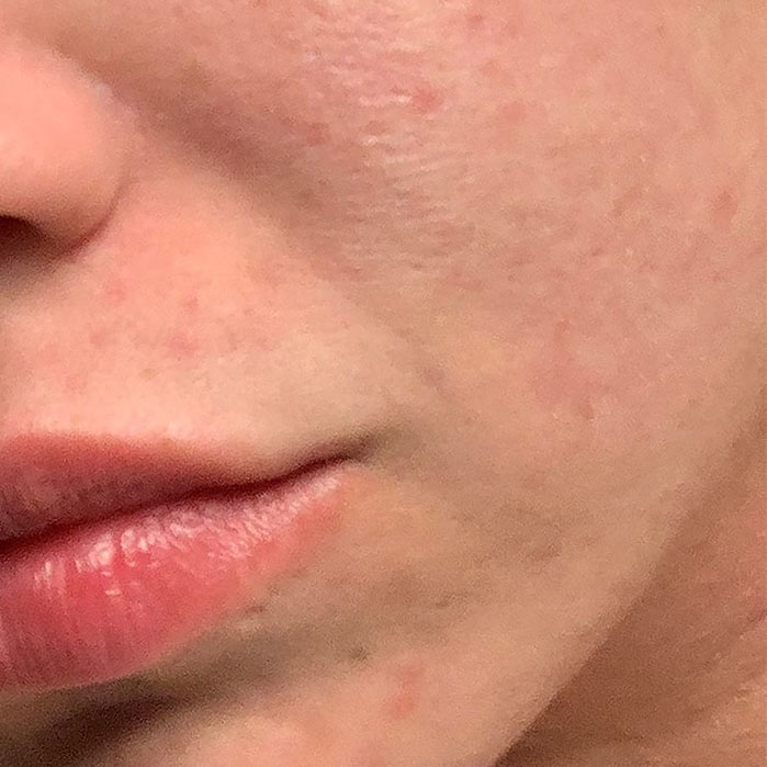 Morpheus8 Treatments