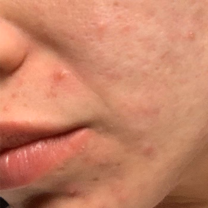 Morpheus8 Treatments