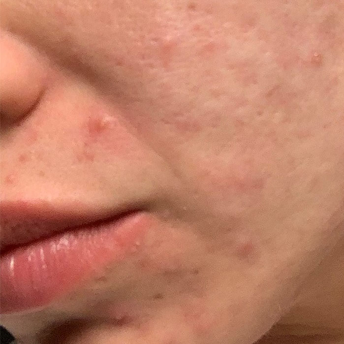 Morpheus8 Treatments