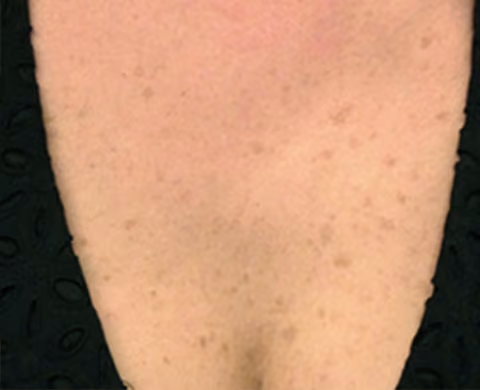 LUMECCA IPL Skin Treatment For Optimal Rejuvenation