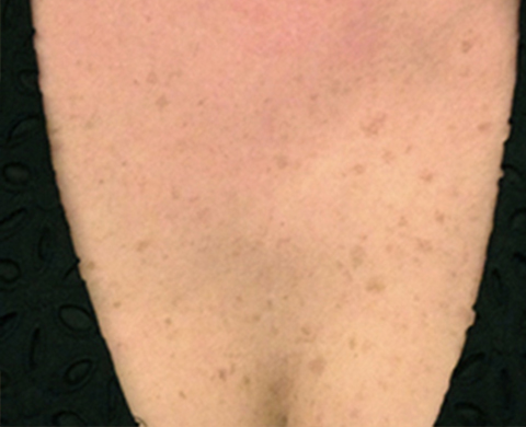 LUMECCA IPL Skin Treatment For Optimal Rejuvenation