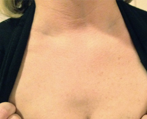 LUMECCA IPL Skin Treatment For Optimal Rejuvenation