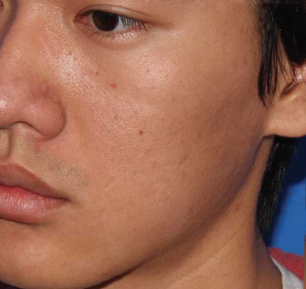 Microneedling