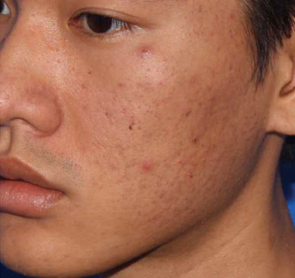 Microneedling