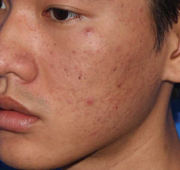Microneedling