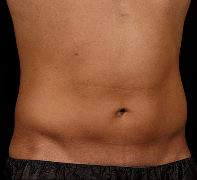 SculpSure® Laser Fat Removal & Body Contouring