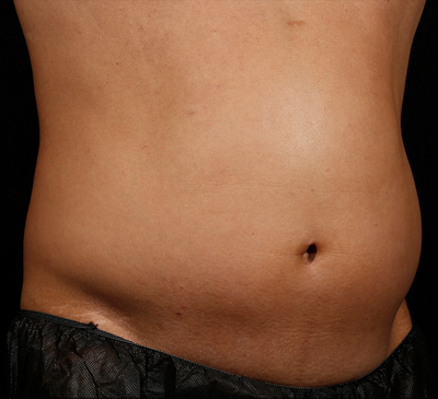 SculpSure® Laser Fat Removal & Body Contouring