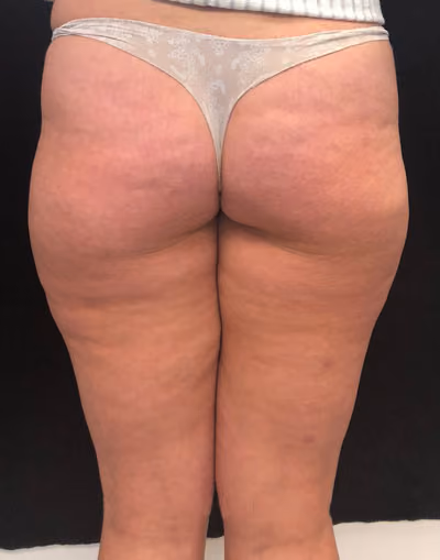 PLUS Radio Frequency Skin Tightening Treatment