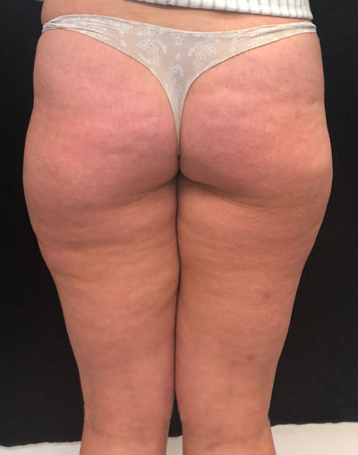 PLUS Radio Frequency Skin Tightening Treatment