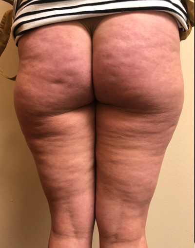 PLUS Radio Frequency Skin Tightening Treatment