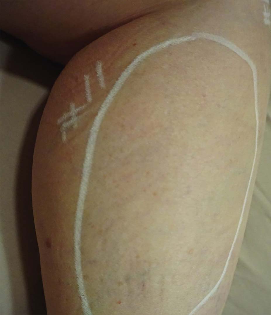 Vasculaze