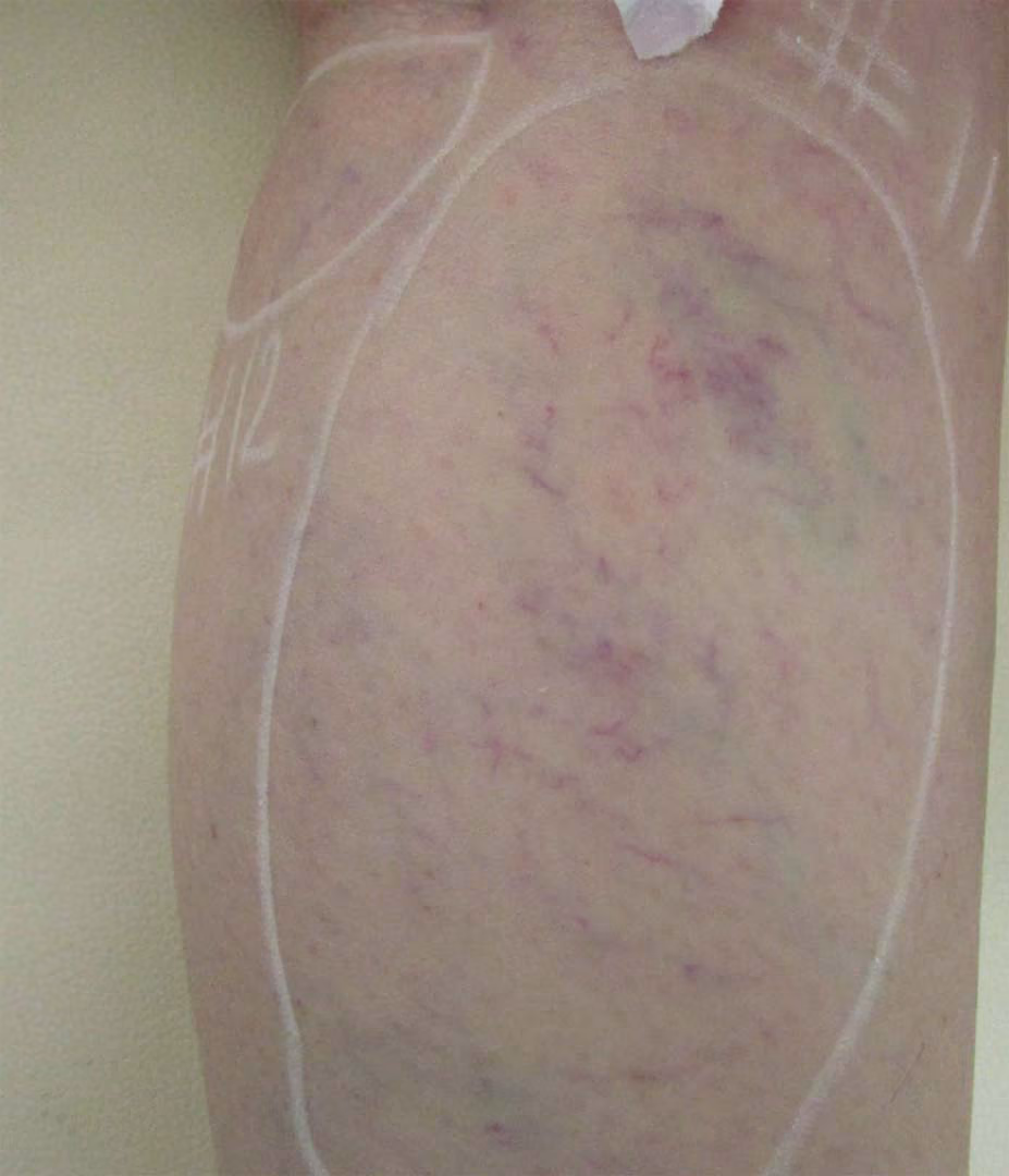 Vasculaze