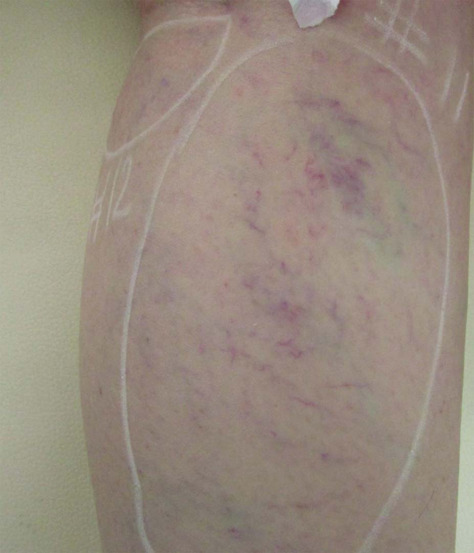 Vasculaze