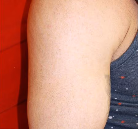 Laser Tattoo Removal