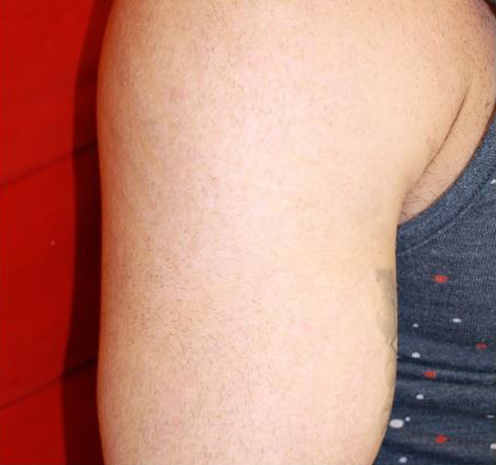 Laser Tattoo Removal