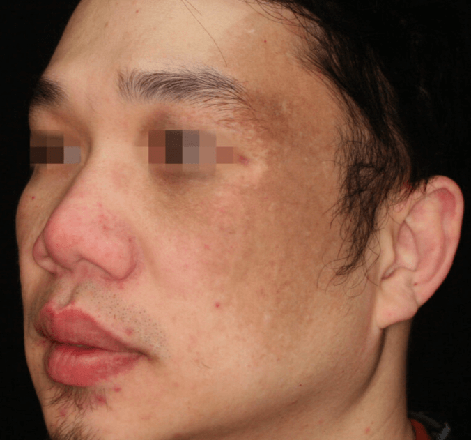 PicoSure Pro Laser Treatments