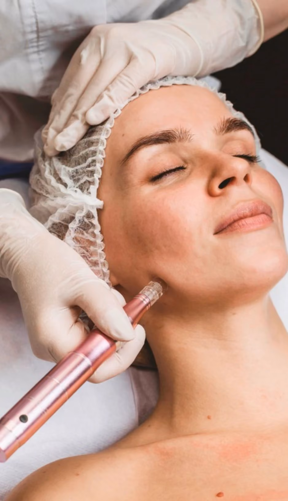 Microneedling