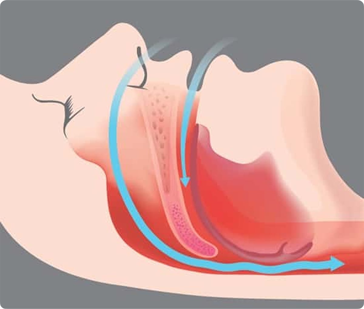 Illustration of snoring process