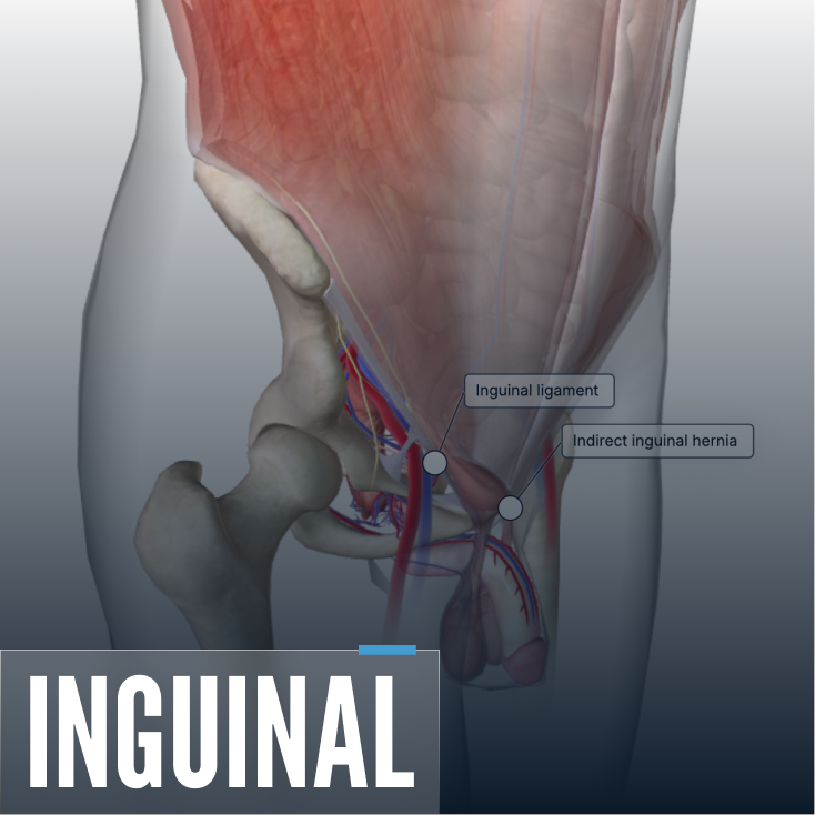 Hernia Repair