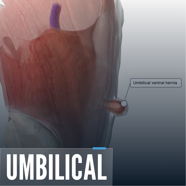 Umbilical Hernia