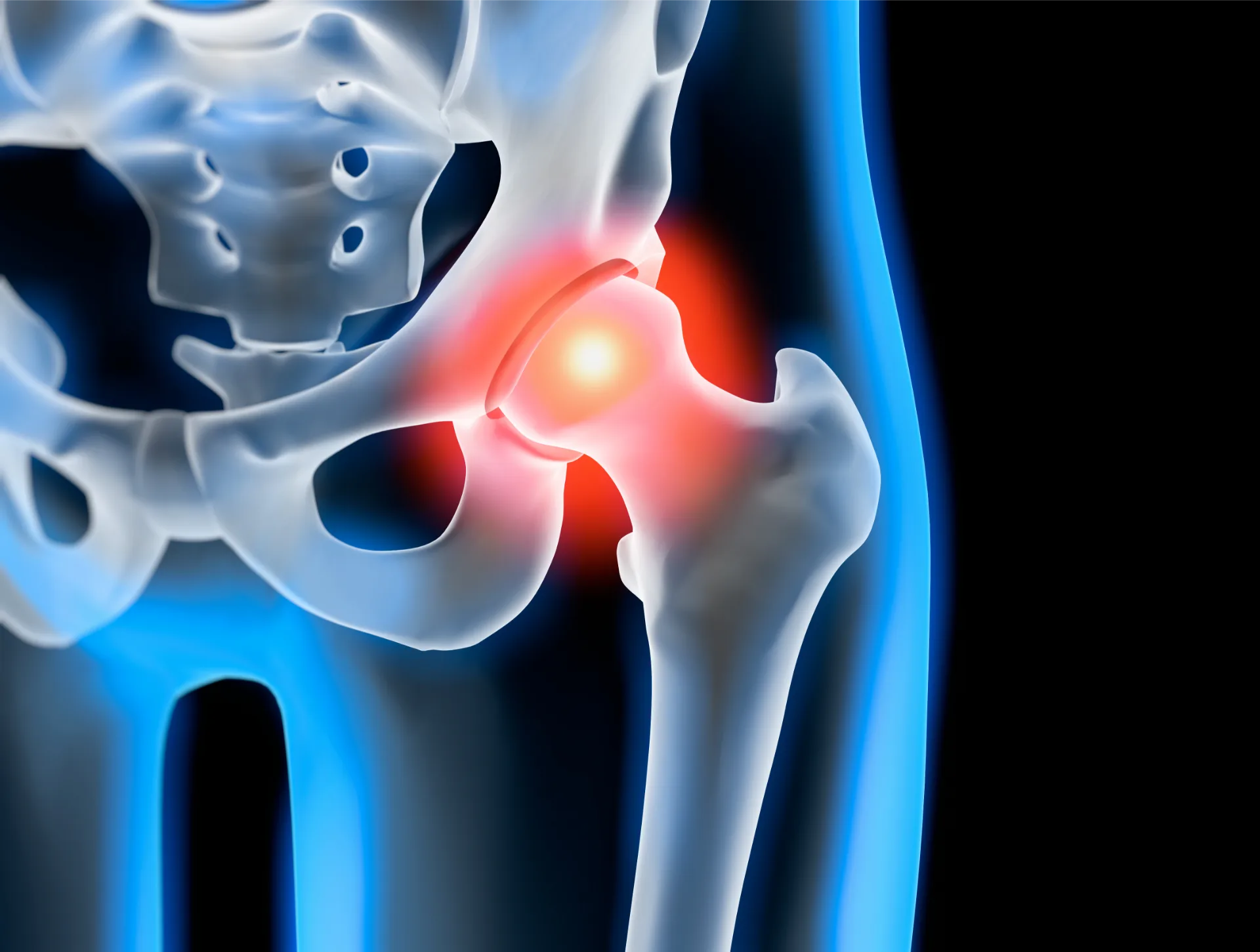 Hüftarthrose – Symptome & Behandlung