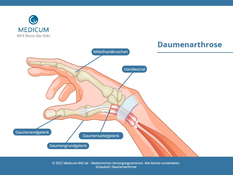Schaubild Daumenarthrose
