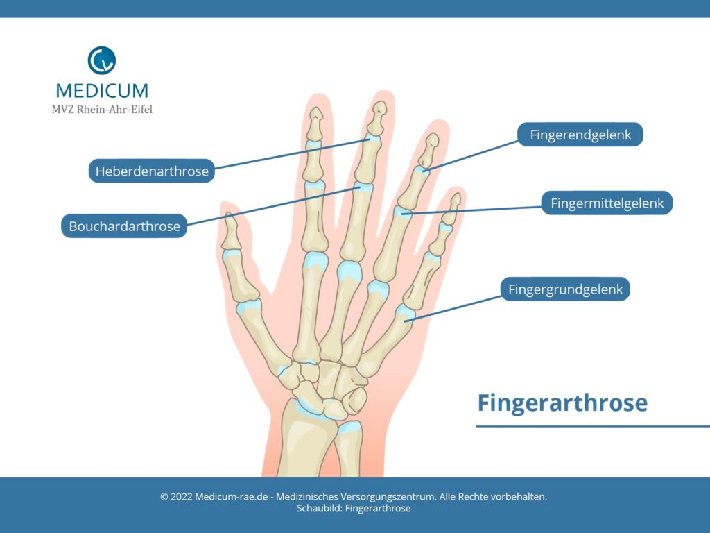 Schaubild Fingerarthrose