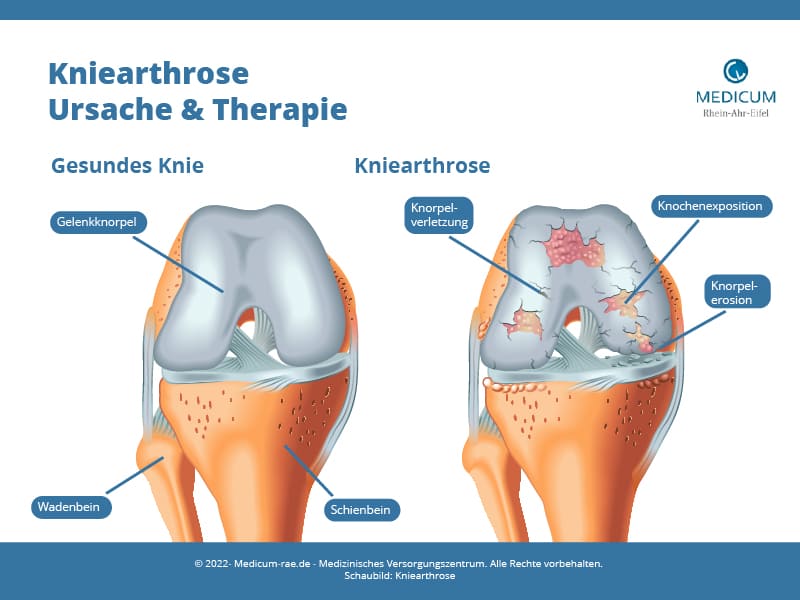 Kniearthrose Schaubild